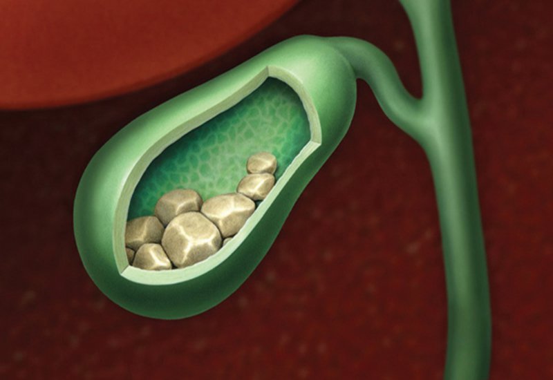 Phẫu thuật mổ sỏi mật tuy đơn giản nhưng vẫn có thể xảy ra biến chứng