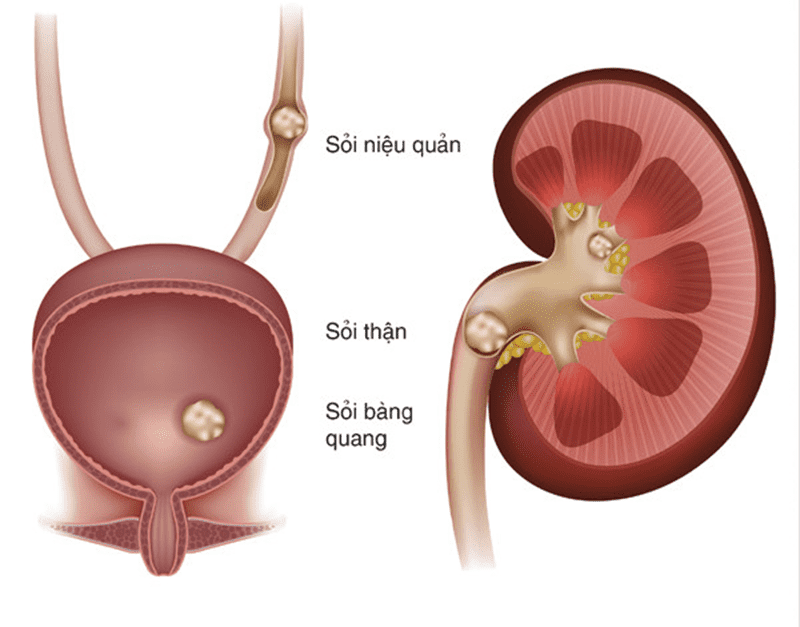 Khi bị sỏi, người bệnh thường cảm thấy đau vùng bụng dưới