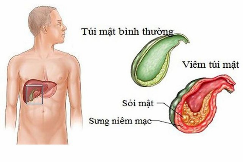 Sỏi túi mật 14mm có thể điều trị bằng phẫu thuật nếu xuất hiện dấu hiệu biến chứng