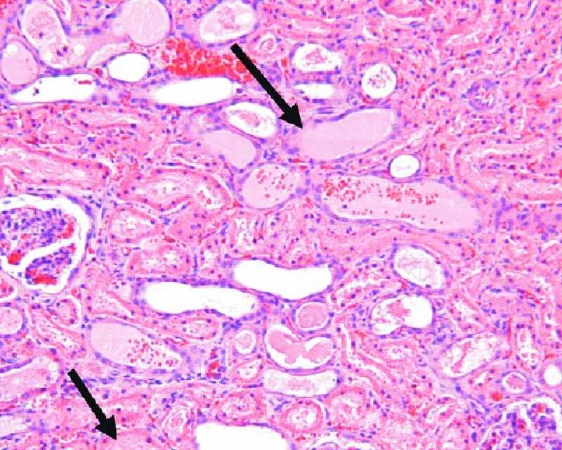 Hình ảnh hiển vi khi ống thận hoại tử ở suy thận cấp thực thể