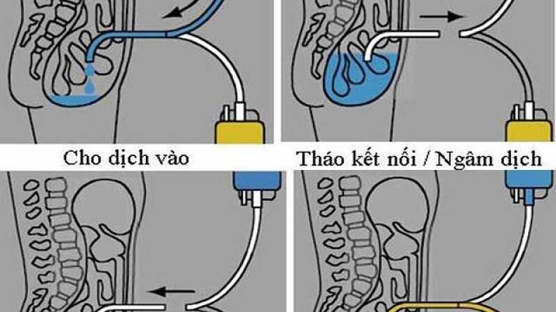 Hình ảnh mô phỏng quá trình lọc màng bụng