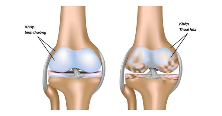 Thoái hóa khớp gối là bệnh lý xương khớp xảy ra phổ biến ở người cao tuổi