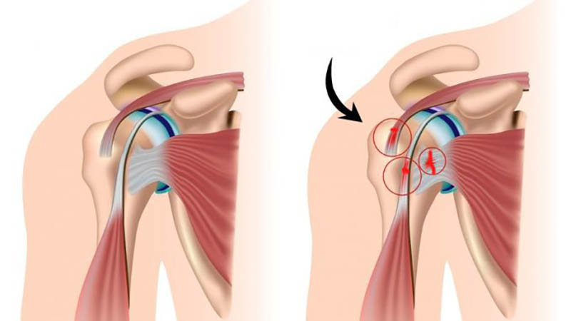 Phẫu thuật khớp vai sẽ được chỉ định khi các biện pháp khác không ngăn được bệnh tiến triển xấu