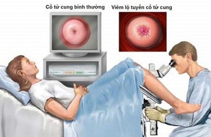 Thời gian điều trị viêm lộ tuyến cổ tử cung