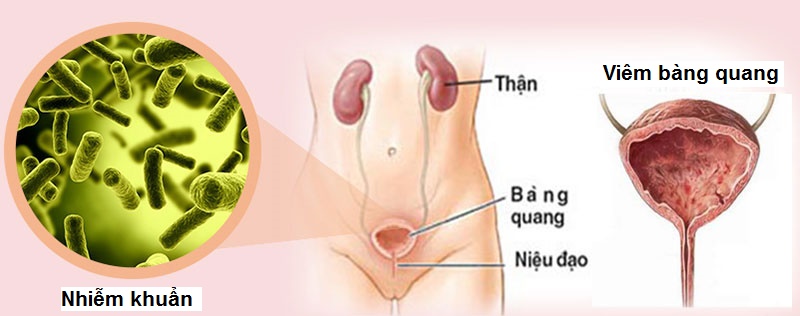 Bàng quang bị viêm là nguyên nhân gây ra tình trạng tiểu buốt có máu