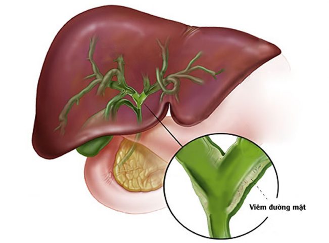 Viêm đường mật là một biến chứng khác của bệnh sỏi mật