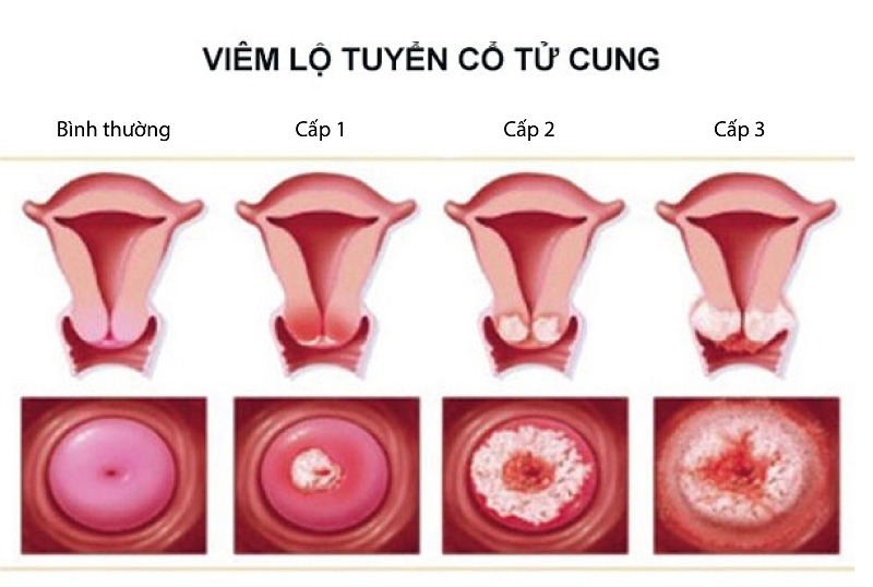 Viêm lộ tuyến 1cm là cấp độ mấy