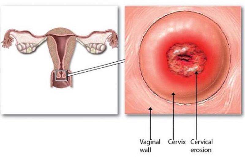 Tổn thương gây ra do viêm lộ tuyến cổ tử cung có màu đỏ và dạng sủi được gọi là viêm lộ tuyến dạng sùi.