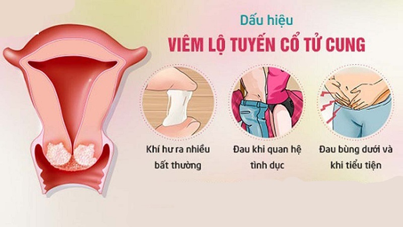 Dấu hiệu viêm lộ tuyến cổ tử cung diện rộng