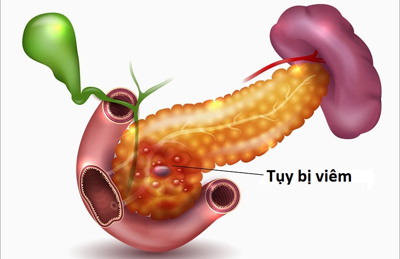 Viêm tụy cấp là trường hợp sỏi từ đường mật rơi xuống vị trí ngã ba đường mật tụy