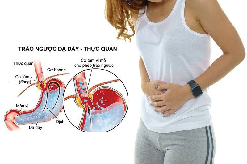 Bệnh trào ngược dạ dày thực quản k21 là tên gọi theo mã hóa y tế của trào ngược dạ dày thực quản.