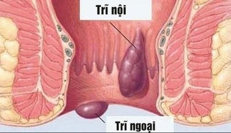 Dấu hiệu bệnh trĩ ở phụ nữ sau sinh