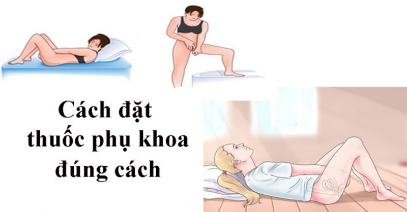 Chị em nên đến bệnh viện để được hướng dẫn cách đặt thuốc phụ khoa đúng cách