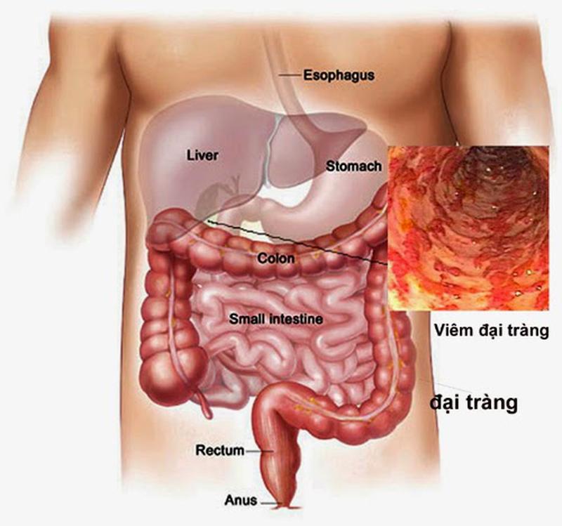 Đau bụng bên trái có thể là triệu chứng bệnh viêm đại tràng