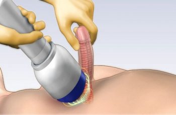 Nguồn gốc của phương pháp điều trị rối loạn cương dương bằng sóng xung kích