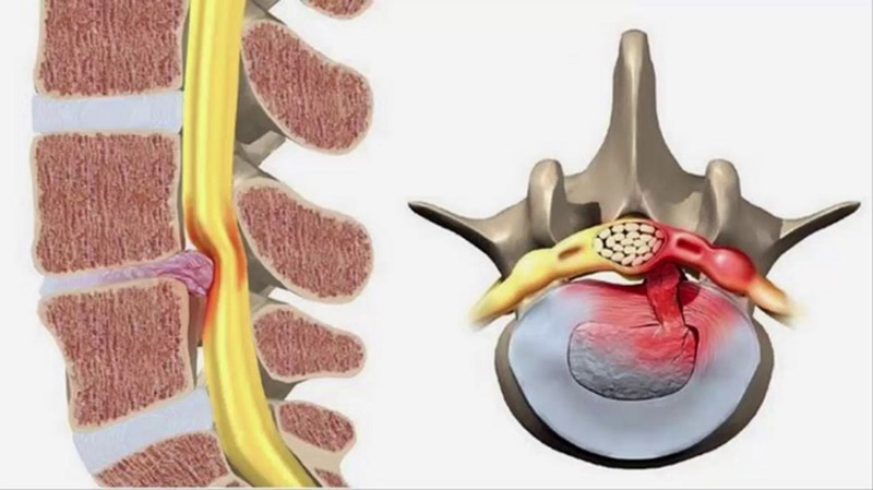 Gai cột sống có thể dẫn đến nhiều biến chứng nguy hiểm cho sức khoẻ người bệnh