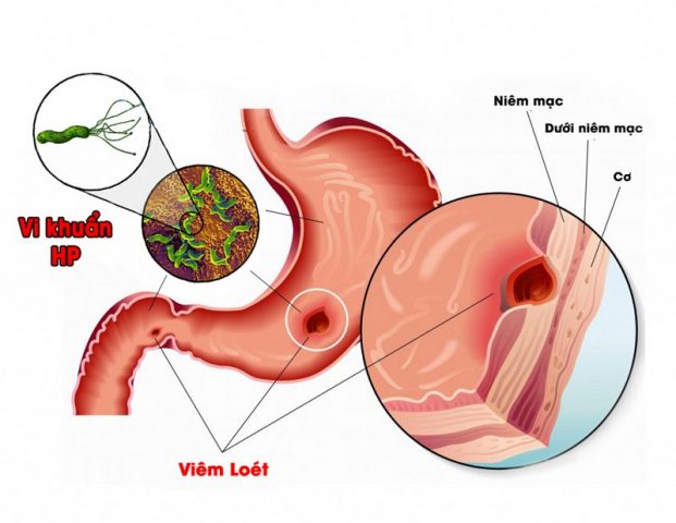 Các vùng viêm loét sẽ tiến triển nặng hơn và gây ra tình trạng vỡ tĩnh mạch, dẫn tới xuất huyết