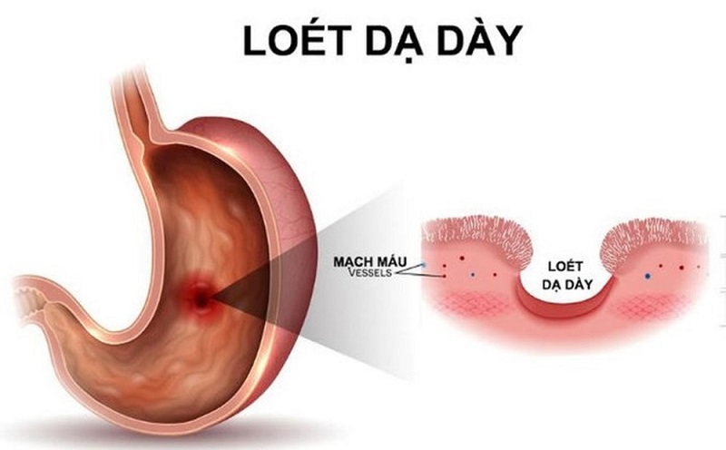 Biến chứng loét dạ dày tá tràng do nhiễm vi khuẩn Hp