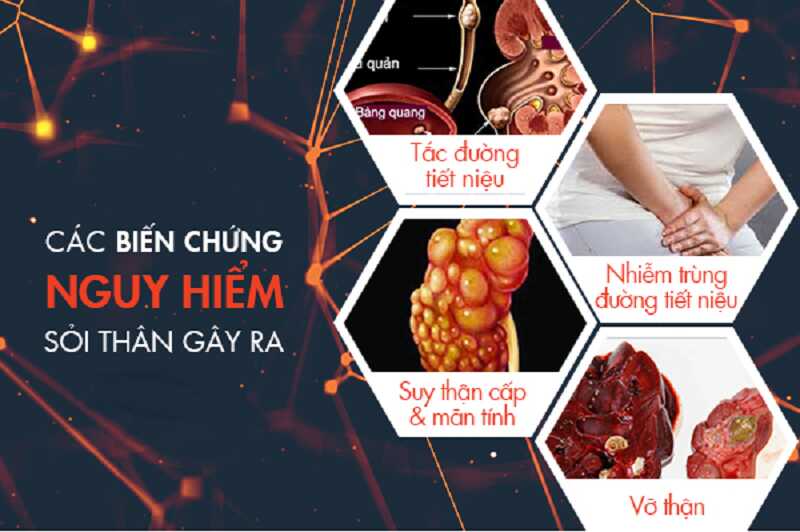 Một số biến chứng do bệnh sỏi thận gây ra