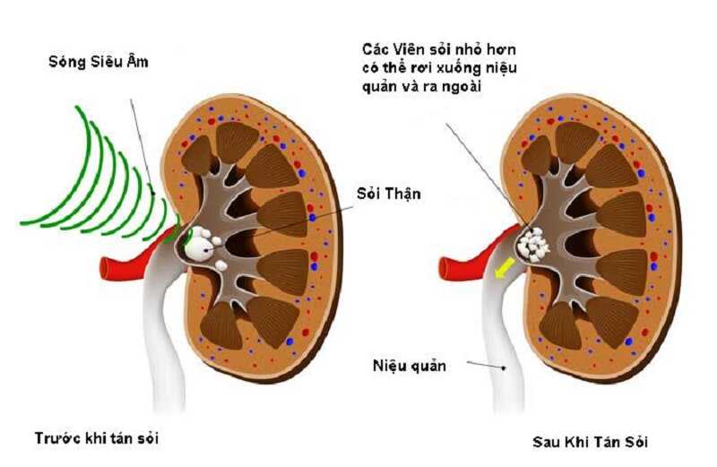 Mô phỏng phương pháp tác sỏi bằng sóng siêu âm, sóng xung kích 