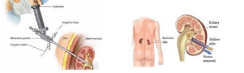 Hình ảnh mô phỏng Phương pháp tán sỏi thận giúp phục hồi nhanh chóng sau phẫu thuật