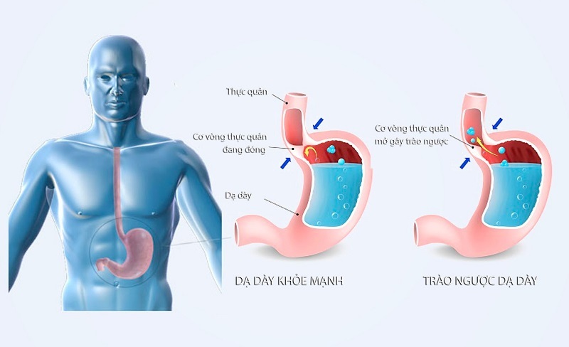 Trào ngược dạ dày đau họng là biến chứng phổ biến ở người mắc tổn thương do acid dịch vị dư thừa