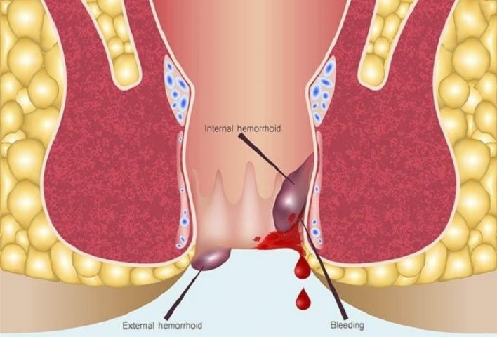 Kích thước của búi trĩ sẽ tăng dần lên và không thể co lại vào bên trong, gây nhiều hệ lụy nguy hiểm.