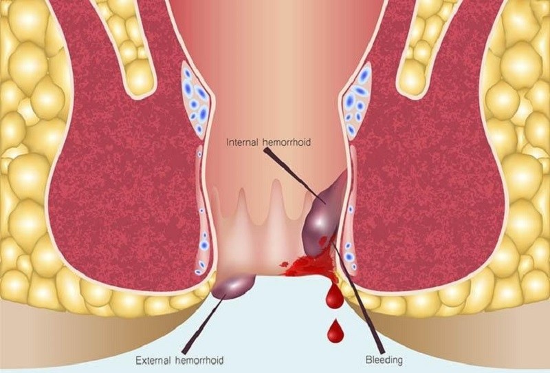 Kích thước của búi trĩ sẽ tăng dần lên và không thể co lại vào bên trong, gây nhiều hệ lụy nguy hiểm.