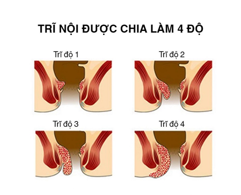 Trĩ nội là hiện tượng phình giãn mạch ở niêm mạc trực tràng.