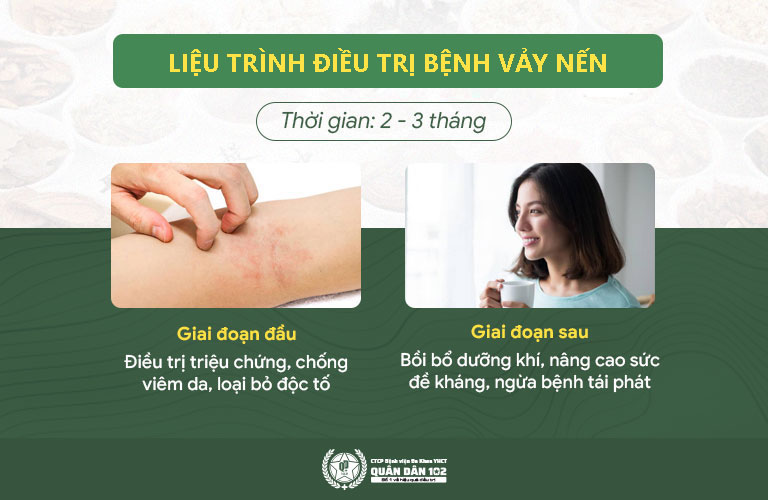 chữa vảy nến tại QUân dân 102