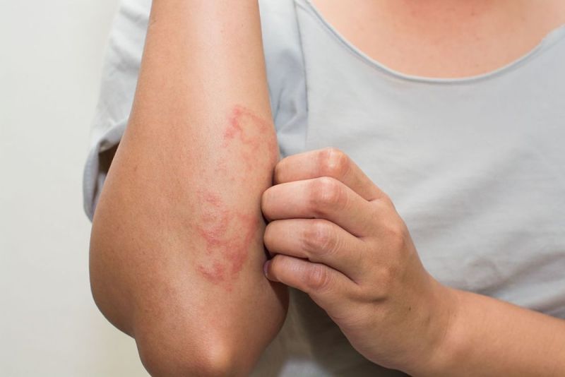 Hình ảnh ệnh eczema