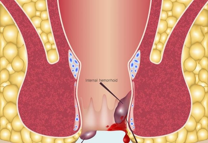 Bệnh trĩ huyết khối là hiện tượng bên trong các búi trĩ xuất hiện các cục máu đông