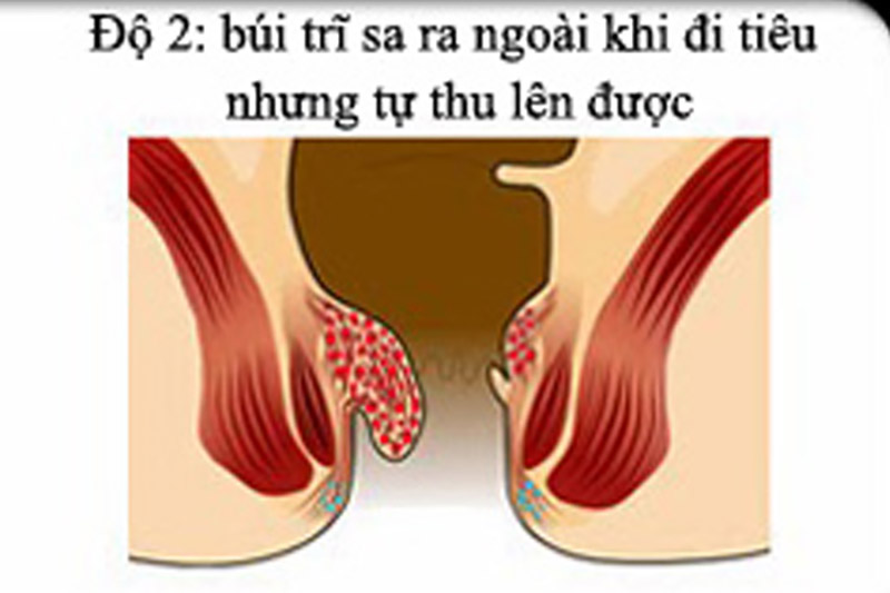 Hình ảnh trĩ ngoại độ 2