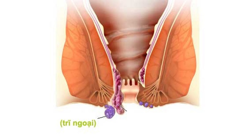 Nếu không được quan tâm kịp thời, trĩ ngoại sẽ gây ra nhiều hậu quả khôn lường