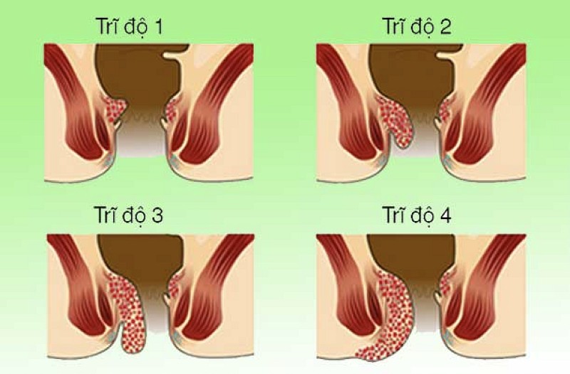 Trĩ nội độ 2 là nỗi ám ảnh của bất cứ người bệnh nào mắc phải.