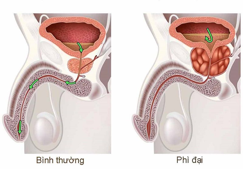 Bệnh phì đại tiền liệt tuyến