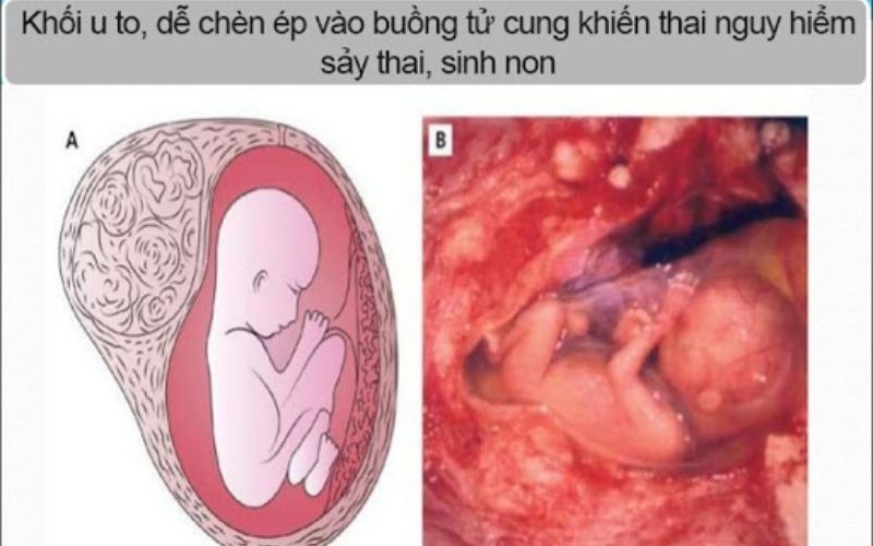 Khối u có thể gây nguy hiểm cho mẹ và bé trong thai kỳ