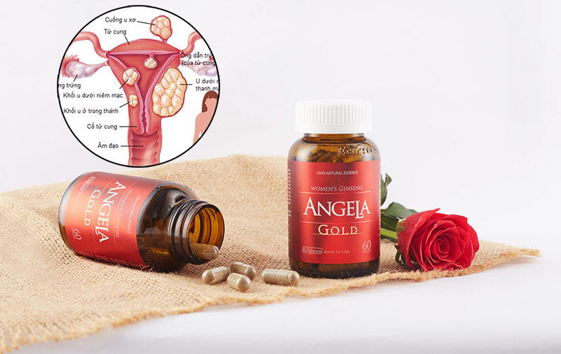 Bệnh nhân u xơ tử cung có thể uống được Angela gold