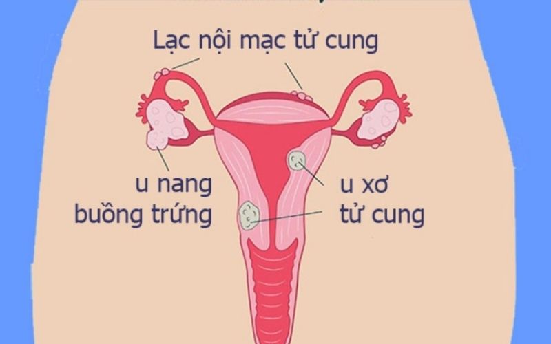 Vị trí của u xơ tử cung và u nang buồng trứng trong hệ cơ quan sinh sản nữ