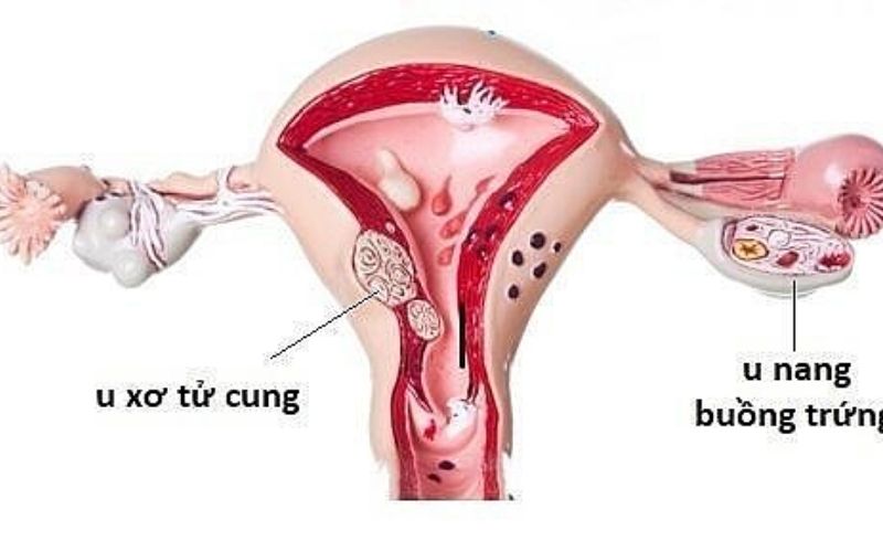 Các khối u phát triển quá lớn cần can thiệp đến phẫu thuật để loại bỏ hoàn toàn