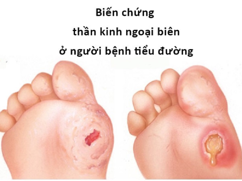 Bệnh tiểu đường bị biến chứng thần kinh