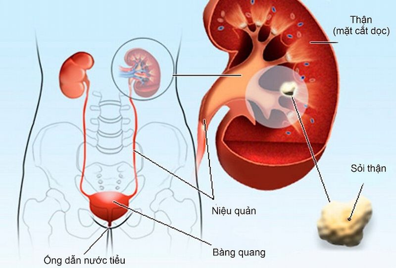 Đau bụng bên trái nữ có thể là dấu hiệu bệnh sỏi thận