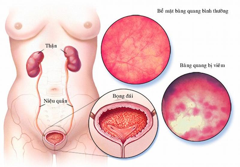 Hình ảnh bàng quan bị viêm dẫn đến cơn đau bụng ở phía dưới bên trái