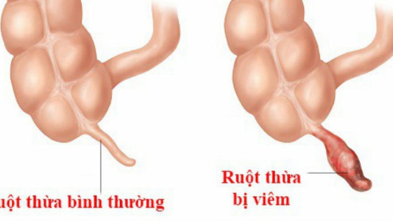 Hình ảnh so sánh tình trạng ruột thừa bị đau và khi không bị đau