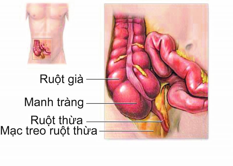 Vị trí ruột thừa trong ổ bụng