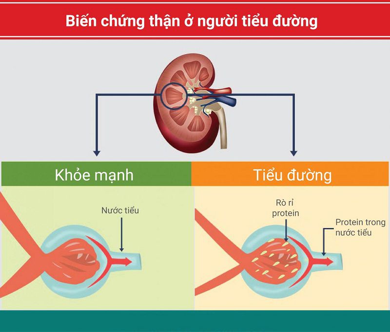 Có rất nhiều nguyên nhân dẫn đến tiểu đường suy thận