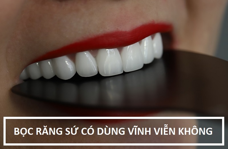 Bọc răng sứ có được vĩnh việc không phụ thuộc vào nhiều yếu tố