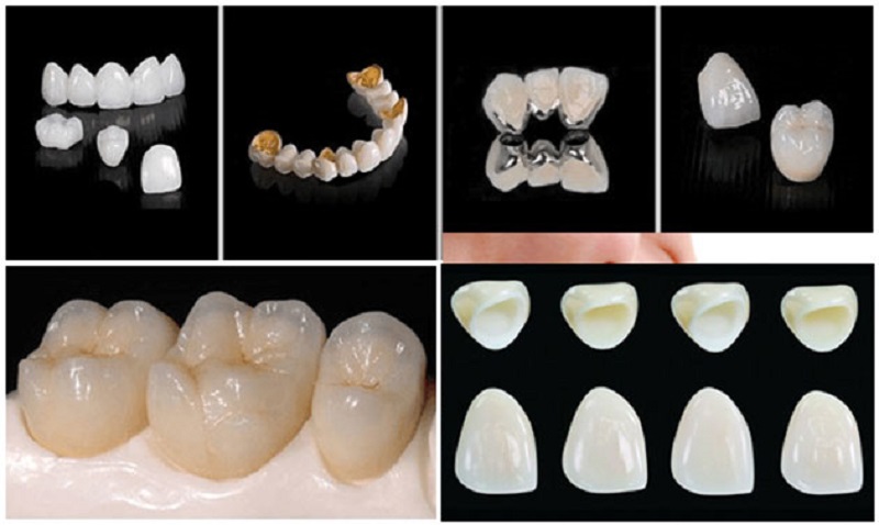 Các loại răng sứ phổ biến