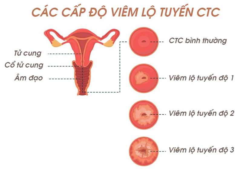 Viêm lộ tuyến là tình trạng bệnh lý thường gặp ở phụ nữ sau sinh