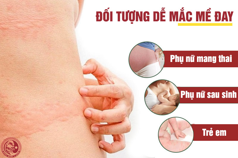 Trẻ em, phụ nữ có thai, phụ nữ sau sinh là những đối tượng dễ bị mề đay, mẩn ngứa